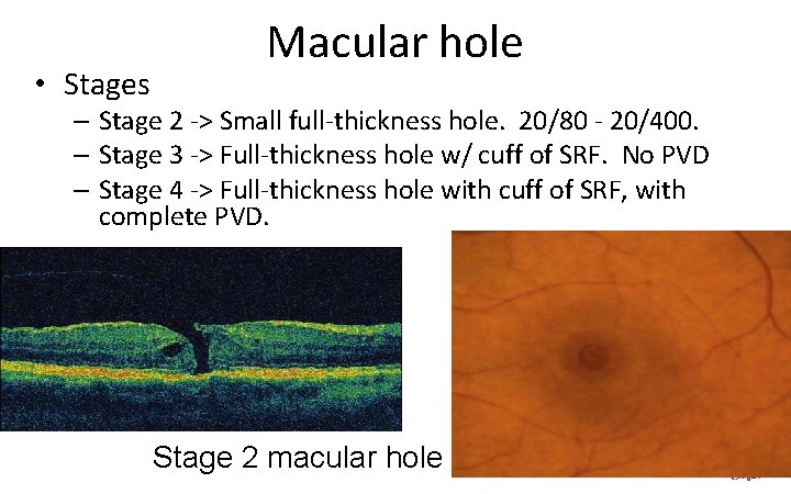 • Stages Macular hole – Stage 2 ‐> Small full‐thickness hole. 20/80 ‐