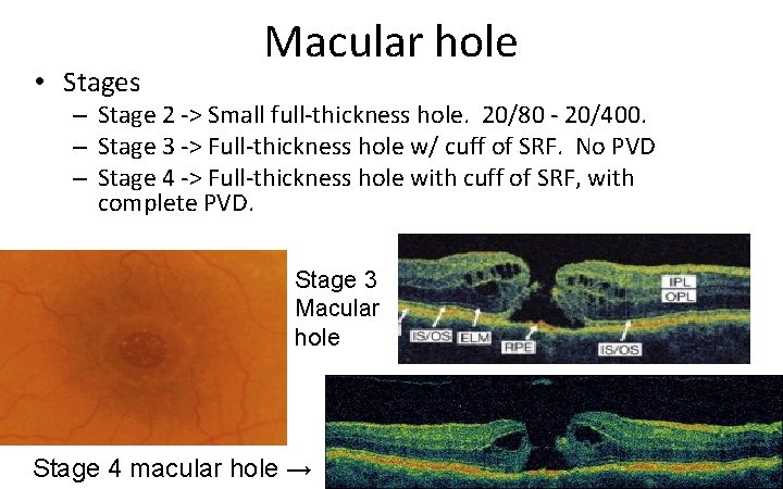  • Stages Macular hole – Stage 2 ‐> Small full‐thickness hole. 20/80 ‐