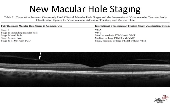 New Macular Hole Staging 