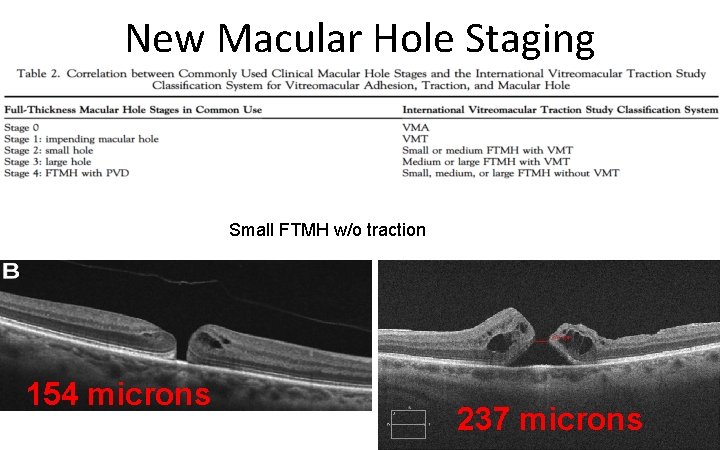 New Macular Hole Staging Small FTMH w/o traction 154 microns 237 microns 