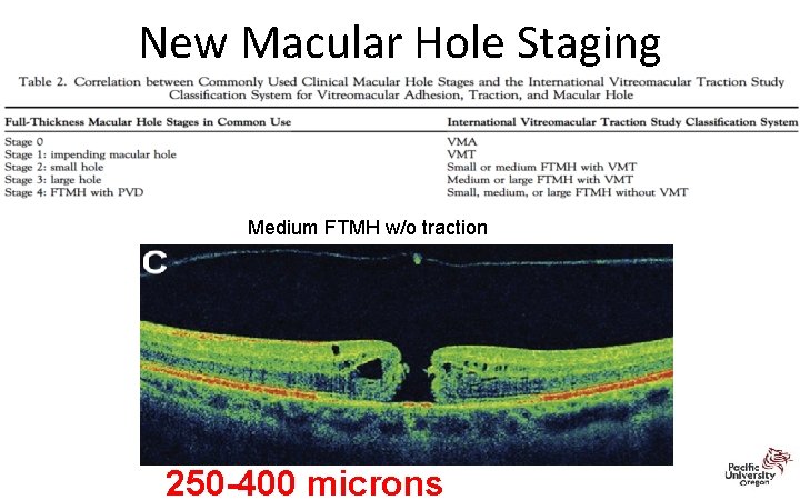 New Macular Hole Staging Medium FTMH w/o traction 250 -400 microns 