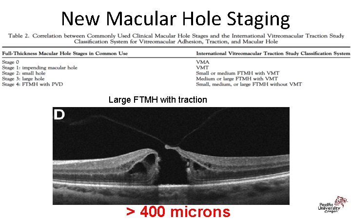 New Macular Hole Staging Large FTMH with traction > 400 microns 