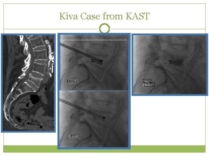 Kiva Case from KAST 