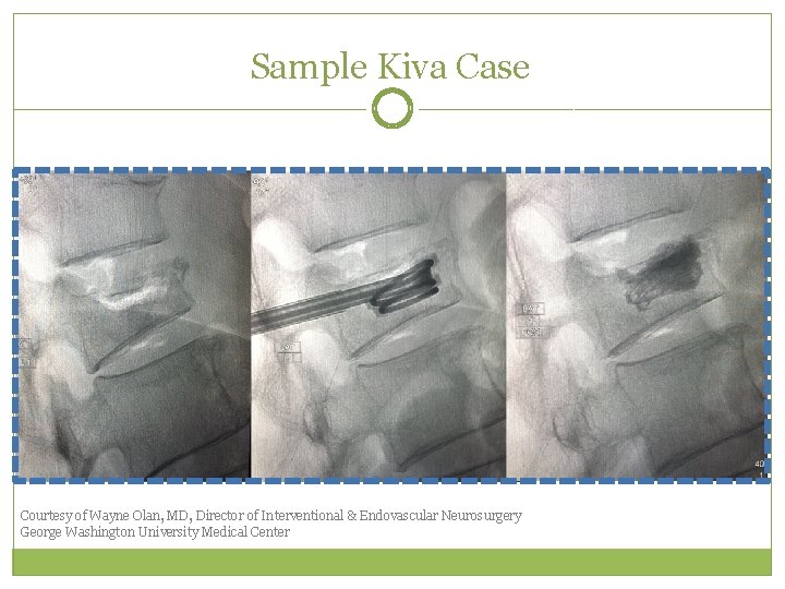 Sample Kiva Case Courtesy of Wayne Olan, MD, Director of Interventional & Endovascular Neurosurgery