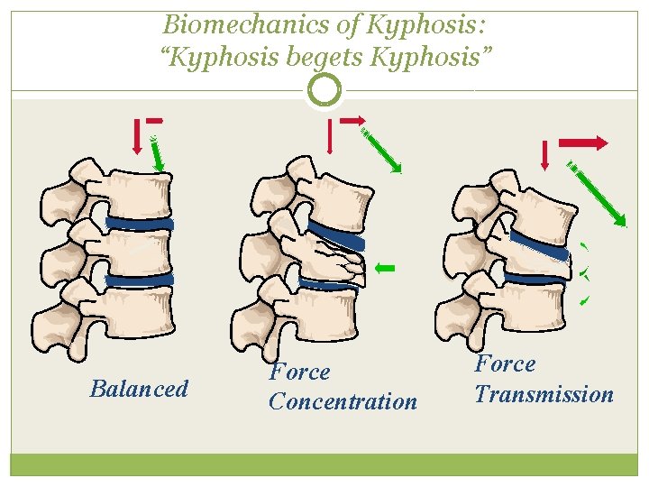Biomechanics of Kyphosis: “Kyphosis begets Kyphosis” Balanced Force Concentration Force Transmission 