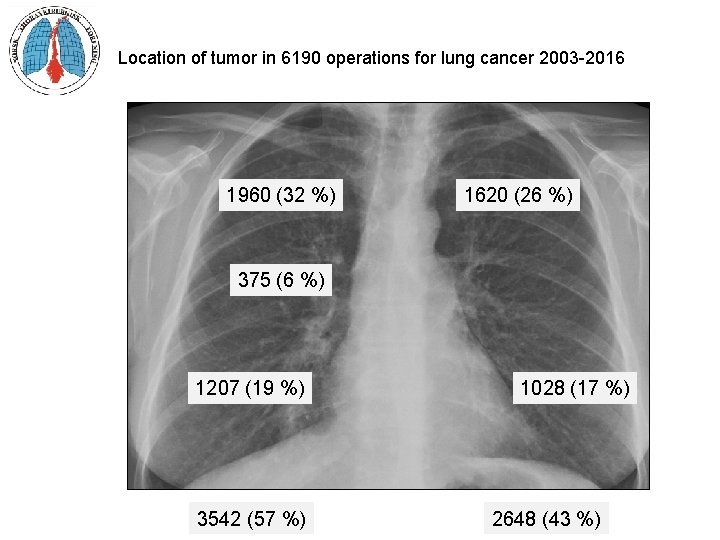 Location of tumor in 6190 operations for lung cancer 2003 -2016 1960 (32 %)