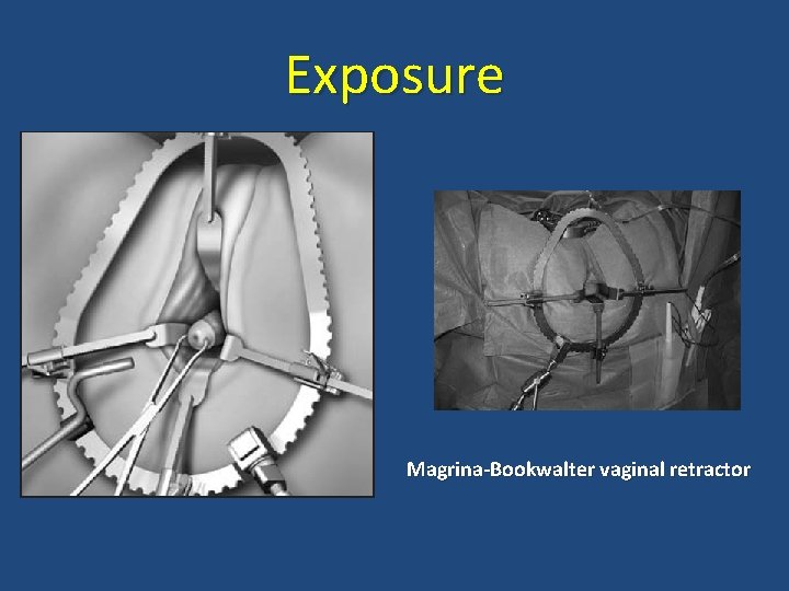 Exposure Magrina-Bookwalter vaginal retractor 