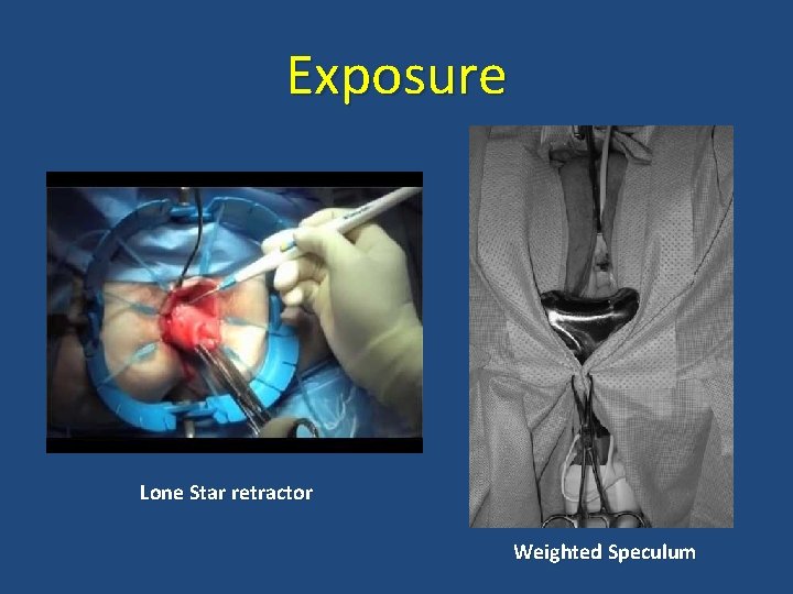 Exposure Lone Star retractor Weighted Speculum 