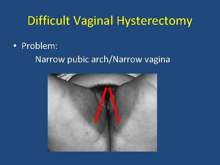 Difficult Vaginal Hysterectomy • Problem: Narrow pubic arch/Narrow vagina 