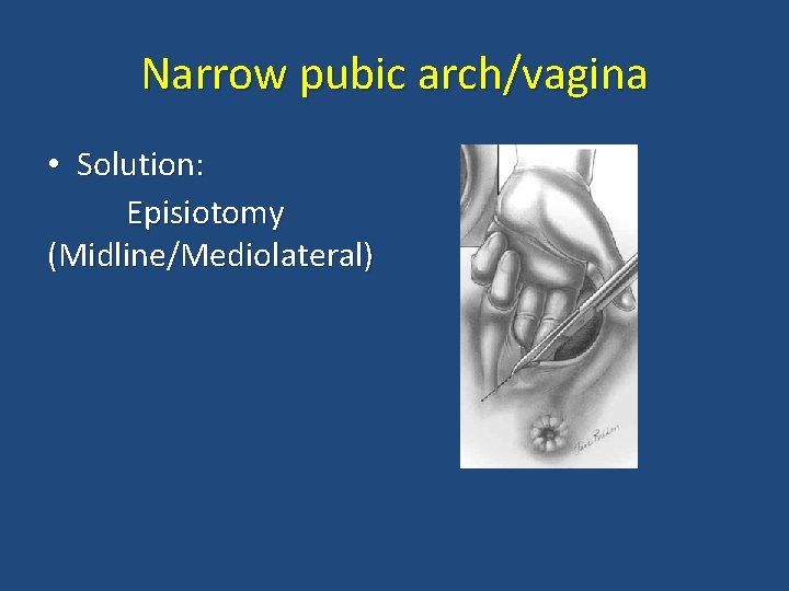 Narrow pubic arch/vagina • Solution: Episiotomy (Midline/Mediolateral) 