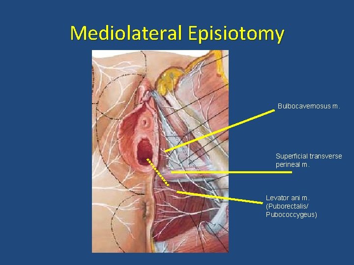 Mediolateral Episiotomy Bulbocavernosus m. Superficial transverse perineal m. Levator ani m. (Puborectalis/ Pubococcygeus) 