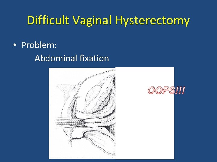 Difficult Vaginal Hysterectomy • Problem: Abdominal fixation OOPS!!! 