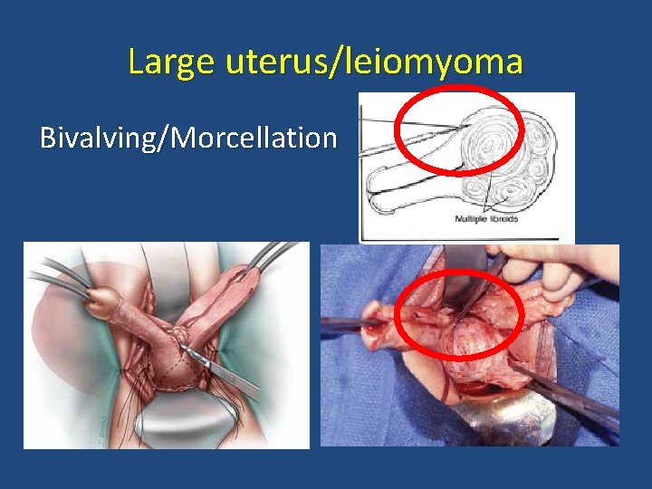 Large uterus/leiomyoma Bivalving/Morcellation 