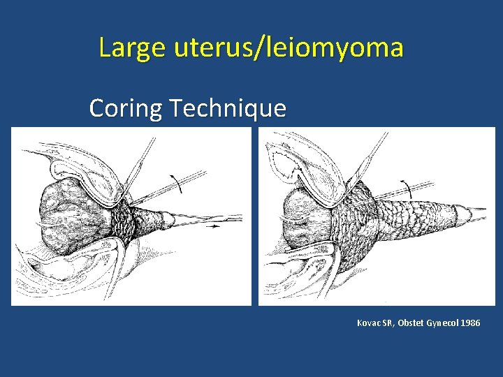 Large uterus/leiomyoma Coring Technique Kovac SR, Obstet Gynecol 1986 