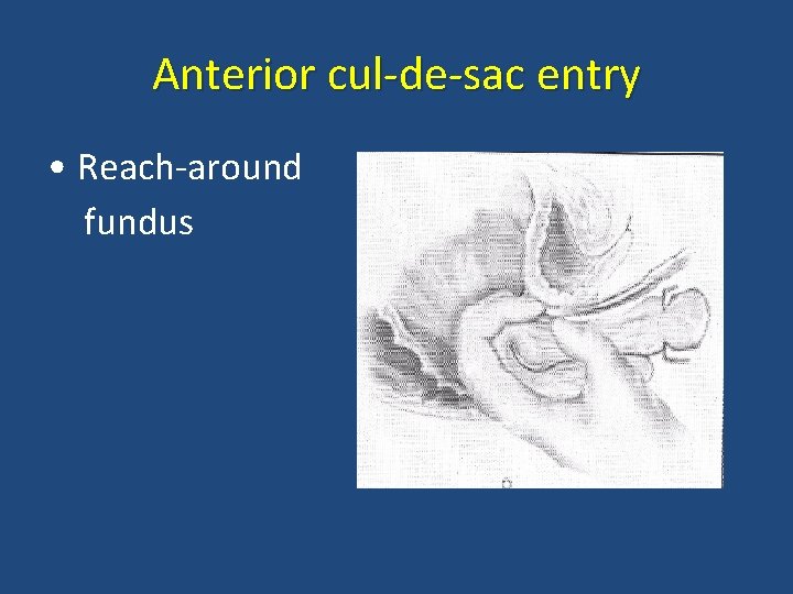 Anterior cul-de-sac entry • Reach-around fundus 