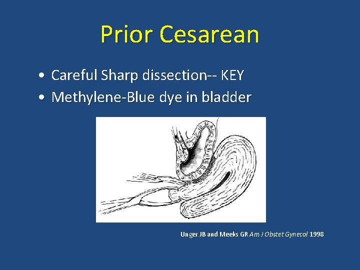 Prior Cesarean • Careful Sharp dissection-- KEY • Methylene-Blue dye in bladder Unger JB Prior Cesarean • Careful Sharp dissection-- KEY • Methylene-Blue dye in bladder Unger JB