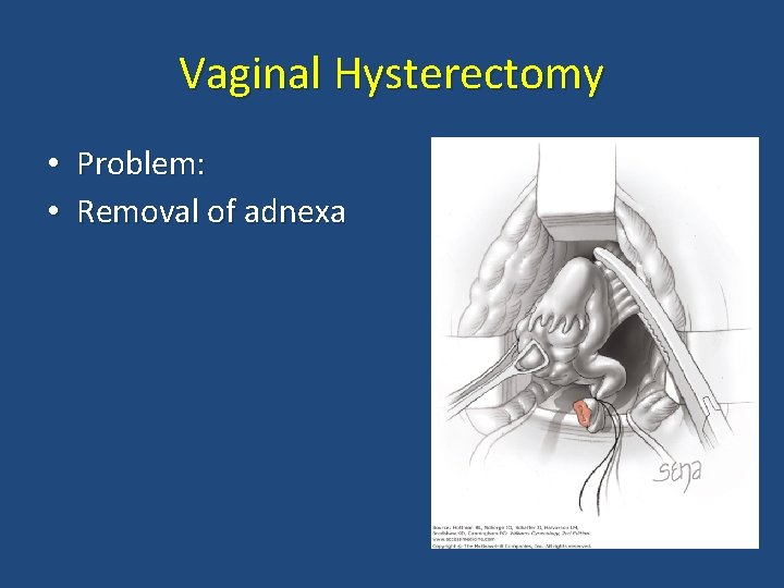 Vaginal Hysterectomy • Problem: • Removal of adnexa 