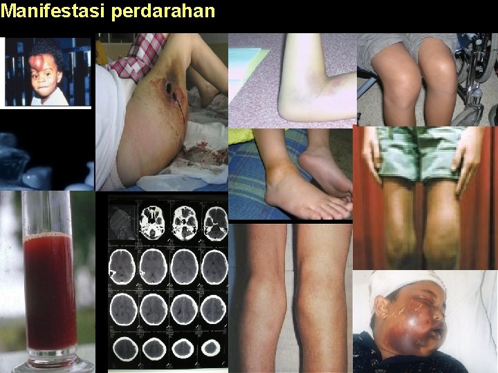 Manifestasi perdarahan 11 