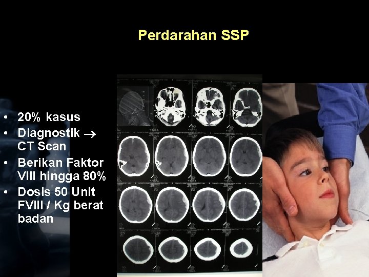 Perdarahan SSP • 20% kasus • Diagnostik CT Scan • Berikan Faktor VIII hingga
