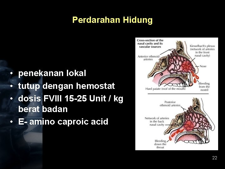 Perdarahan Hidung • penekanan lokal • tutup dengan hemostat • dosis FVIII 15 -25