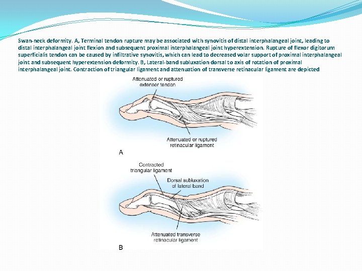 Swan-neck deformity. A, Terminal tendon rupture may be associated with synovitis of distal interphalangeal