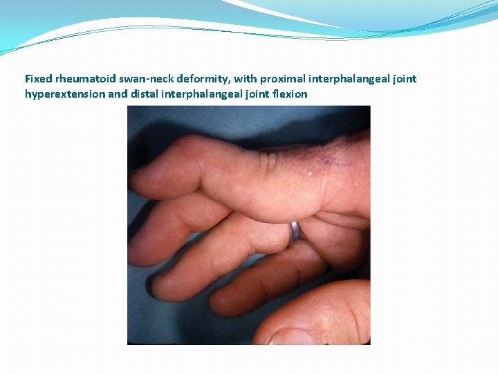Fixed rheumatoid swan-neck deformity, with proximal interphalangeal joint hyperextension and distal interphalangeal joint flexion