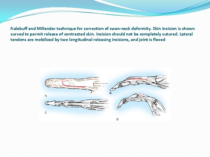 Nalebuff and Millender technique for correction of swan-neck deformity. Skin incision is shown curved