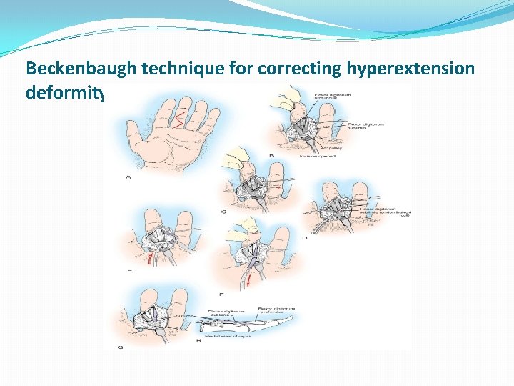 Beckenbaugh technique for correcting hyperextension deformity of proximal interphalangeal joint 