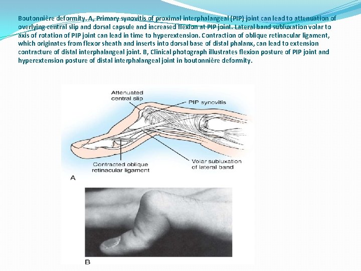 Boutonnière deformity. A, Primary synovitis of proximal interphalangeal (PIP) joint can lead to attenuation