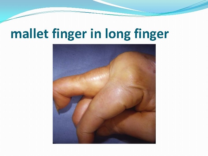 mallet finger in long finger 