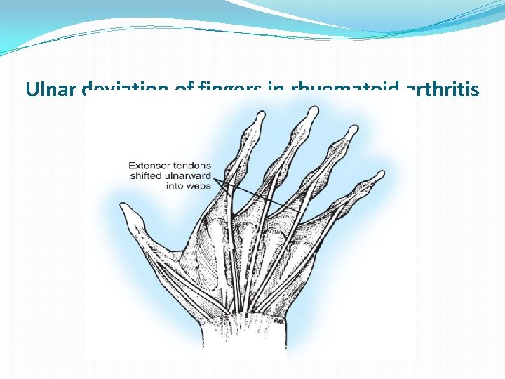 Ulnar deviation of fingers in rhuematoid arthritis 