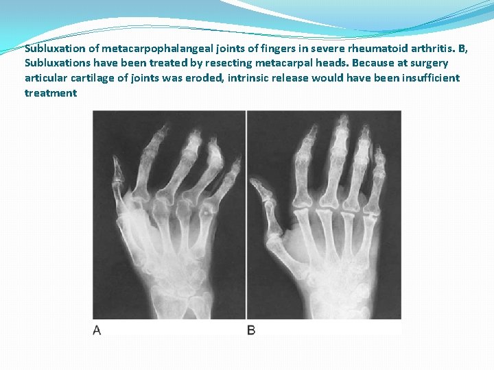 Subluxation of metacarpophalangeal joints of fingers in severe rheumatoid arthritis. B, Subluxations have been