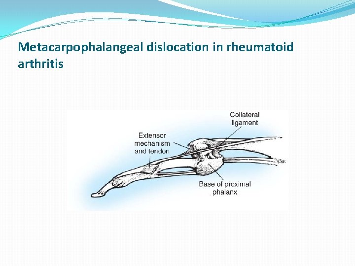 Metacarpophalangeal dislocation in rheumatoid arthritis 