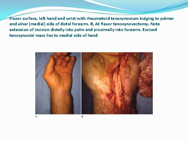 Flexor surface, left hand wrist with rheumatoid tenosynovium bulging to palmar and ulnar (medial)