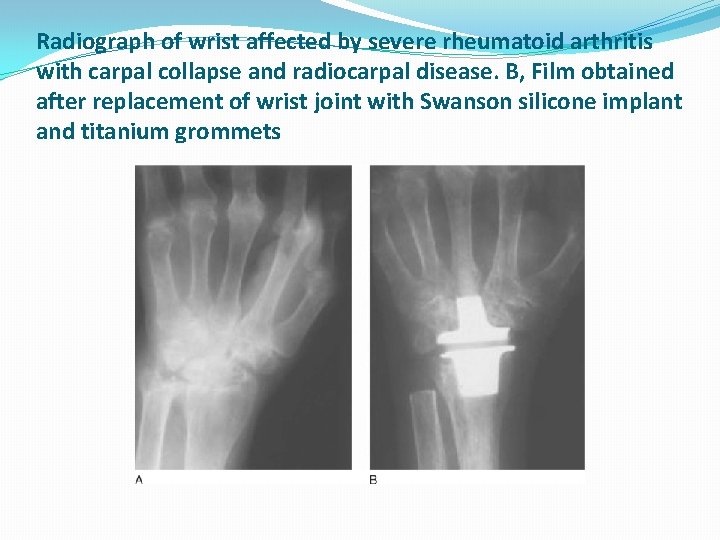 Radiograph of wrist affected by severe rheumatoid arthritis with carpal collapse and radiocarpal disease.