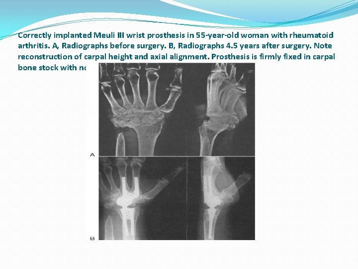 Correctly implanted Meuli III wrist prosthesis in 55 -year-old woman with rheumatoid arthritis. A,