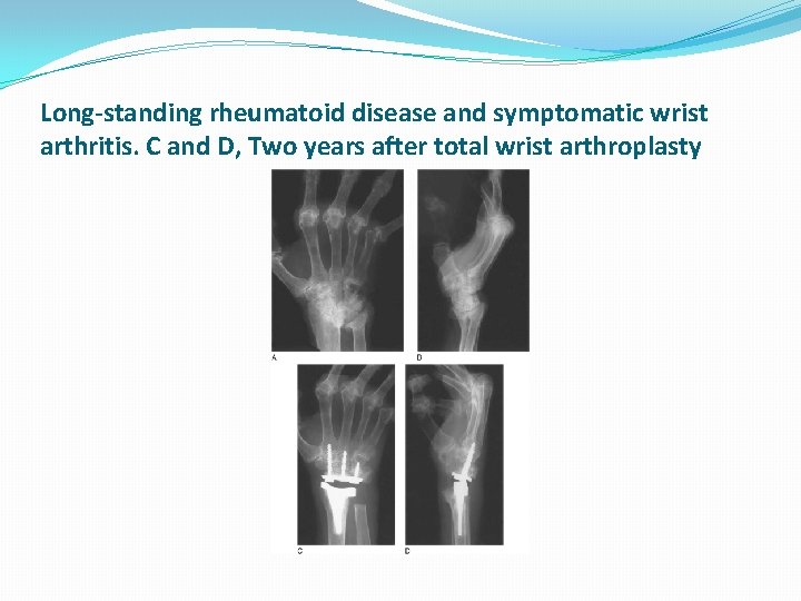 Long-standing rheumatoid disease and symptomatic wrist arthritis. C and D, Two years after total