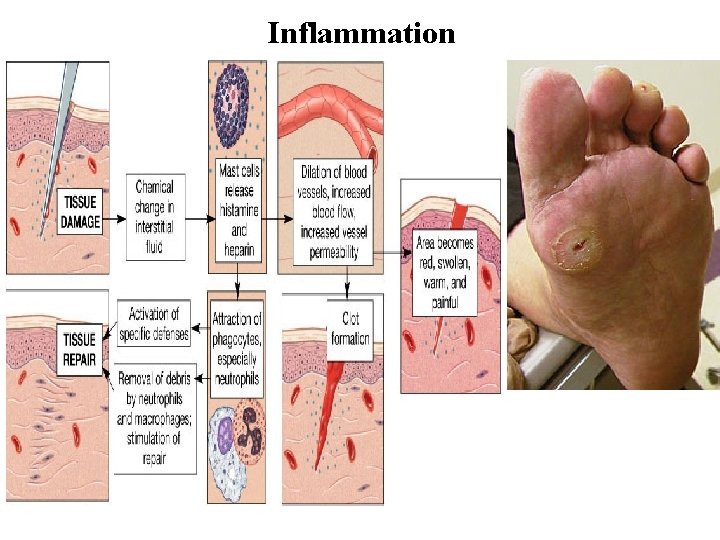 Inflammation Diabetic foot ulcer 