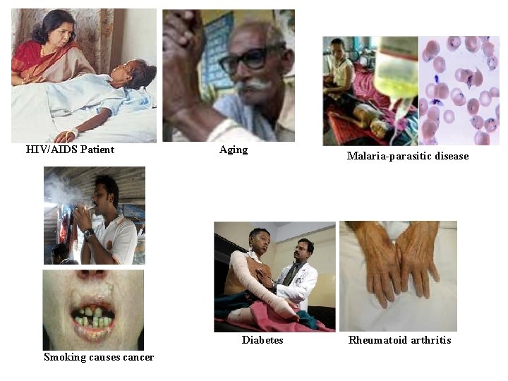 HIV/AIDS Patient Aging Malaria-parasitic disease Diabetes Rheumatoid arthritis Smoking causes cancer 