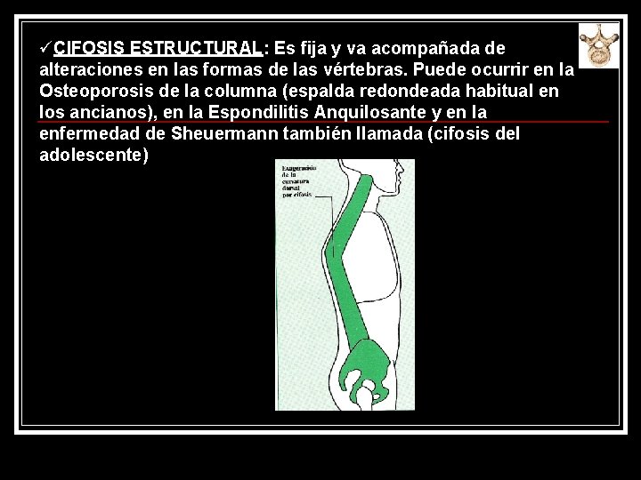 üCIFOSIS ESTRUCTURAL: Es fija y va acompañada de alteraciones en las formas de las