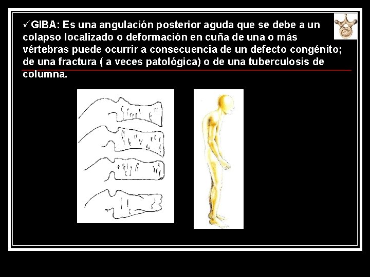 üGIBA: Es una angulación posterior aguda que se debe a un colapso localizado o