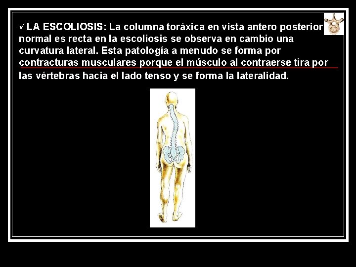 üLA ESCOLIOSIS: La columna toráxica en vista antero posterior normal es recta en la