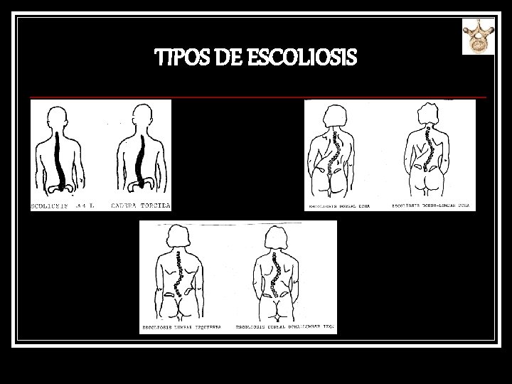 TIPOS DE ESCOLIOSIS 