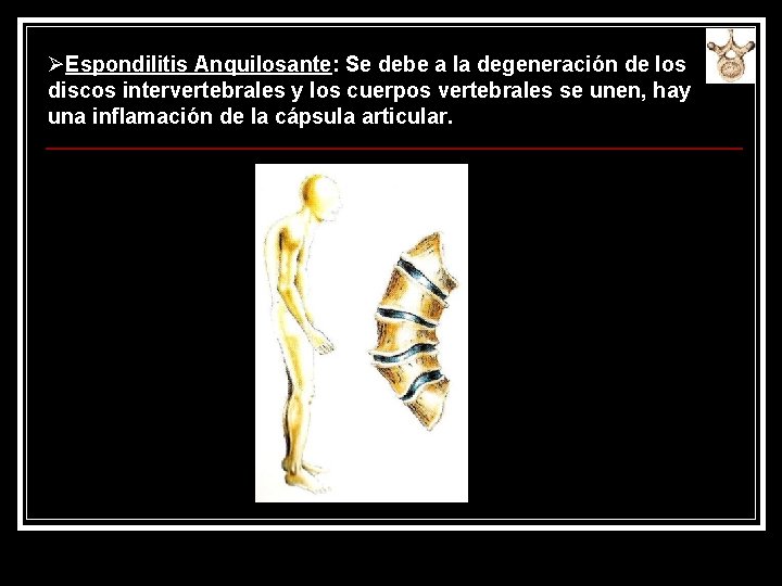 ØEspondilitis Anquilosante: Se debe a la degeneración de los discos intervertebrales y los cuerpos