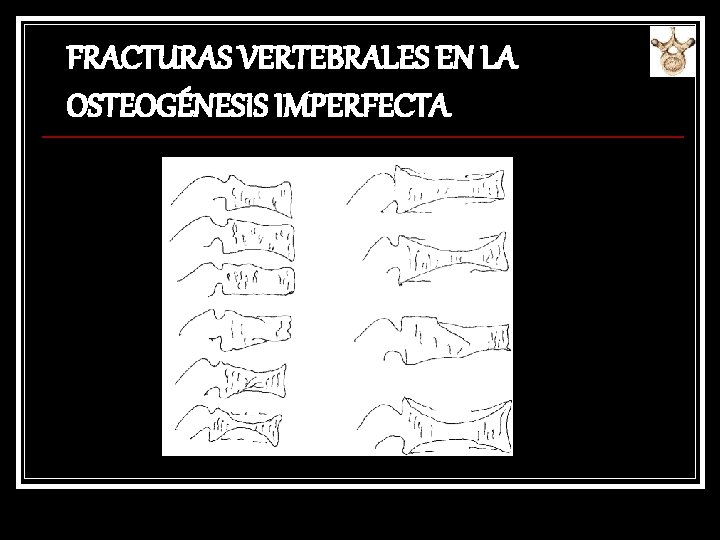 FRACTURAS VERTEBRALES EN LA OSTEOGÉNESIS IMPERFECTA 