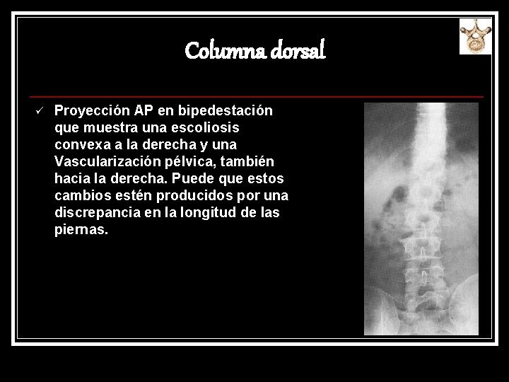 Columna dorsal ü Proyección AP en bipedestación que muestra una escoliosis convexa a la