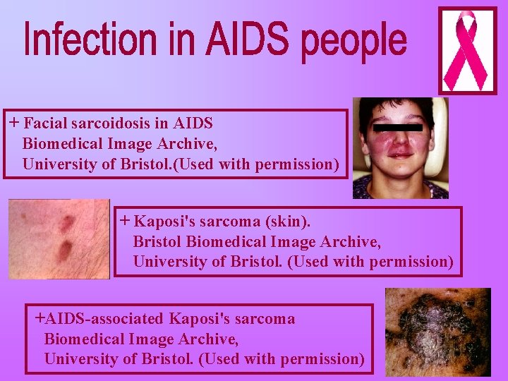 + Facial sarcoidosis in AIDS Biomedical Image Archive, University of Bristol. (Used with permission)
