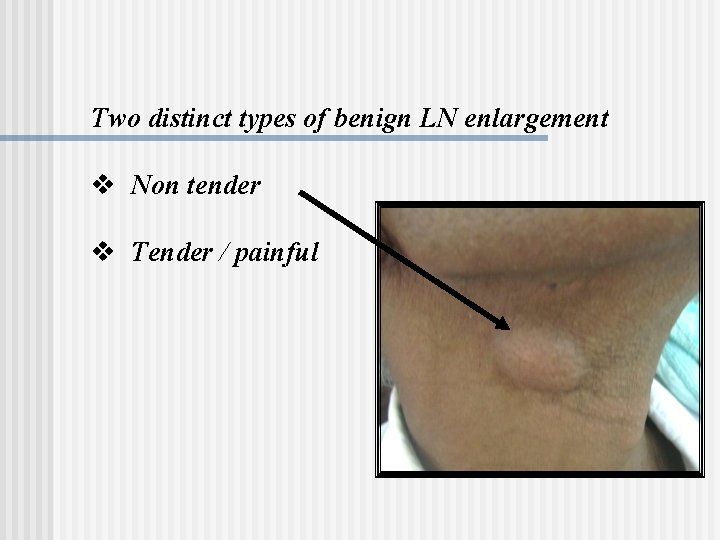 Two distinct types of benign LN enlargement v Non tender v Tender / painful