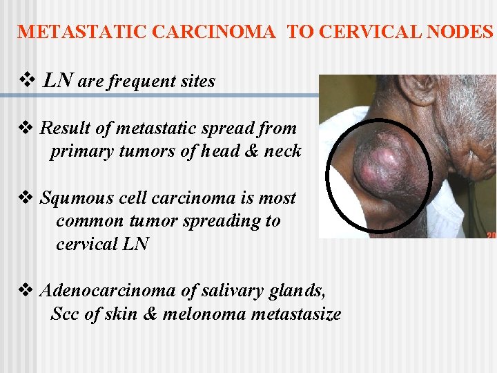 METASTATIC CARCINOMA TO CERVICAL NODES v LN are frequent sites v Result of metastatic