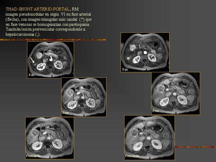 THAD-SHUNT ARTERIO-PORTAL, RM: imagen pseudonodular en segm. VI en fase arterial (flecha), con imagen